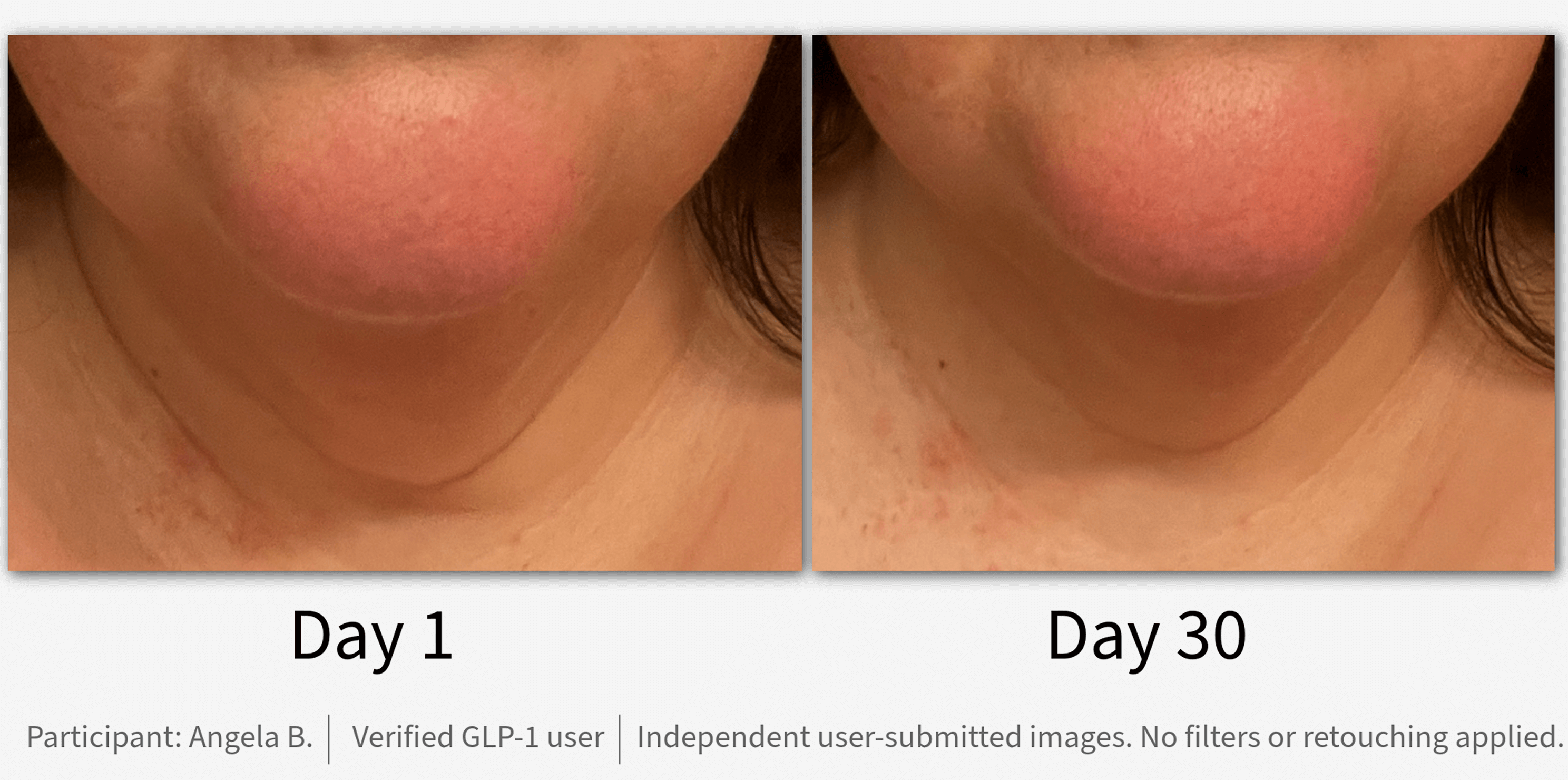 Comparison of chin area between Day 1 and Day 30.