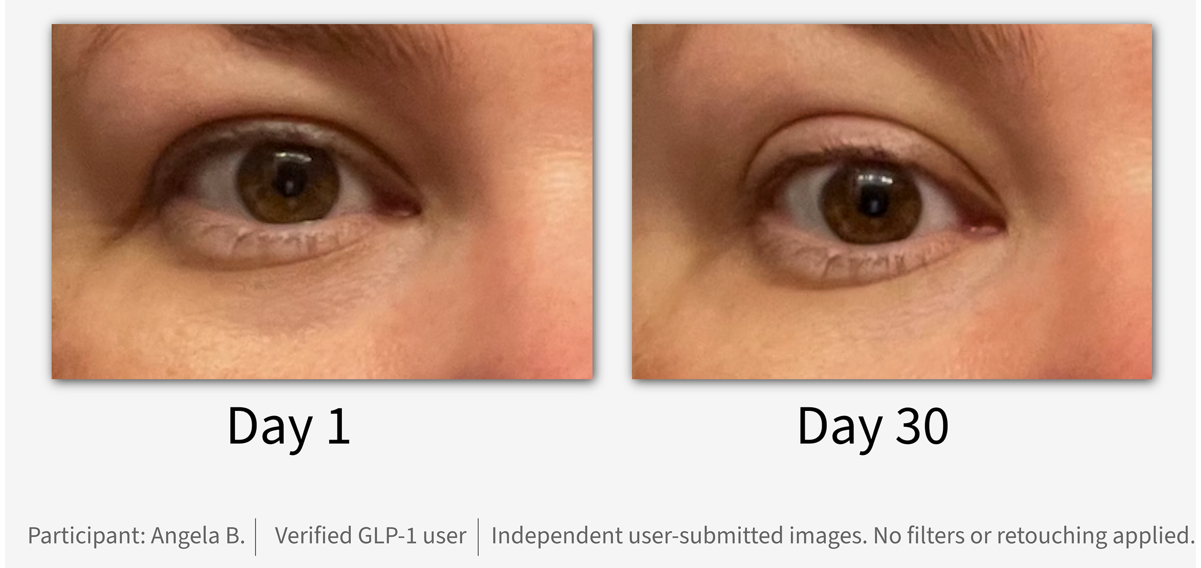 Comparison of two close-up images of eyes, labeled Day 1 and Day 30.