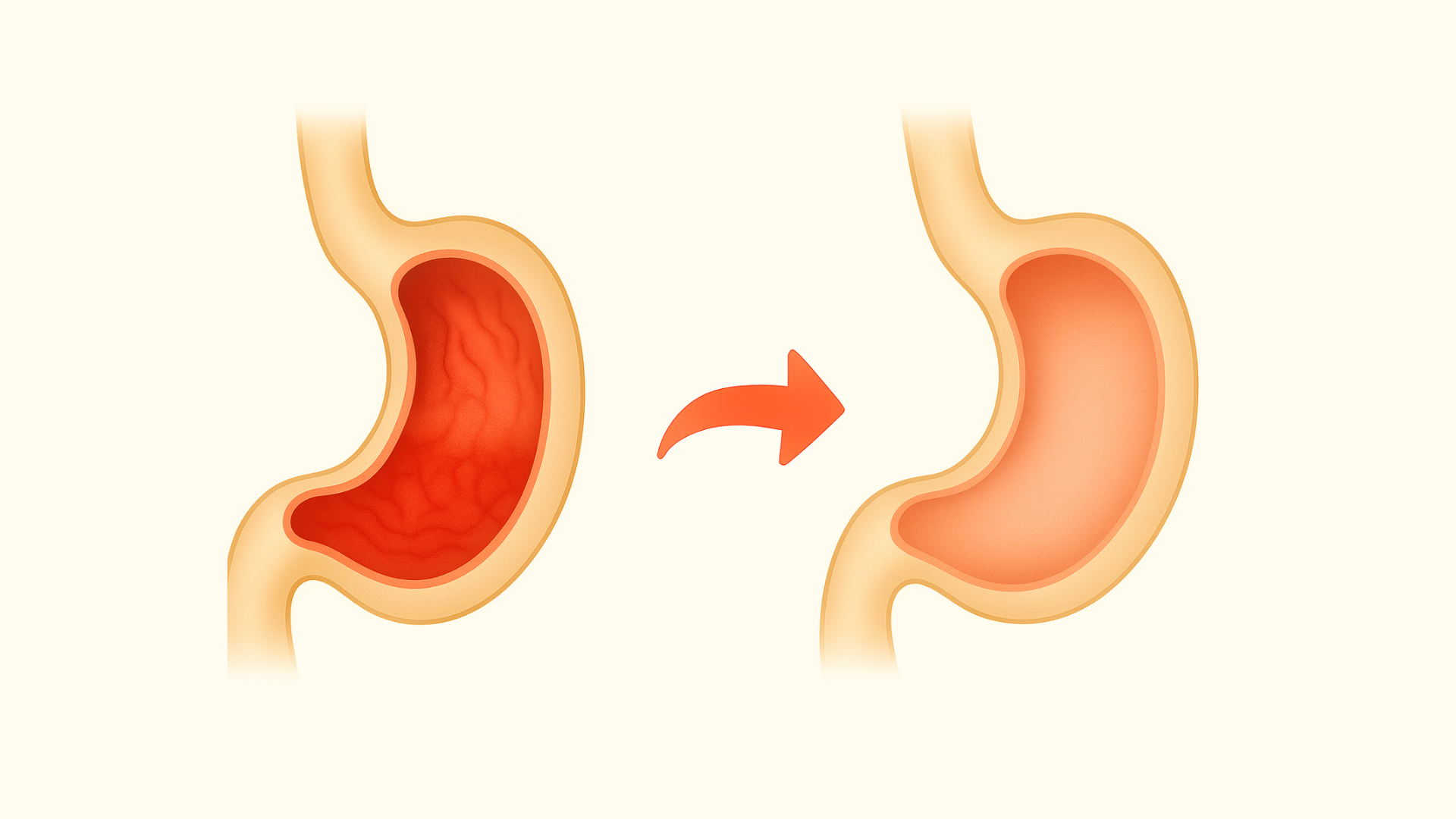 Illustration of two stomachs with an arrow in between.