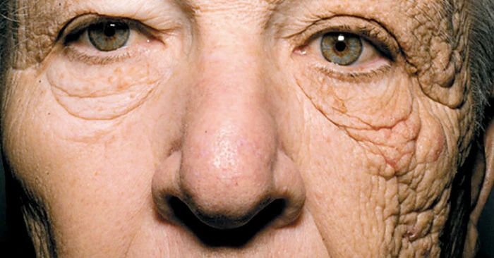 Close-up of an elderly person's face showing wrinkles and skin texture.