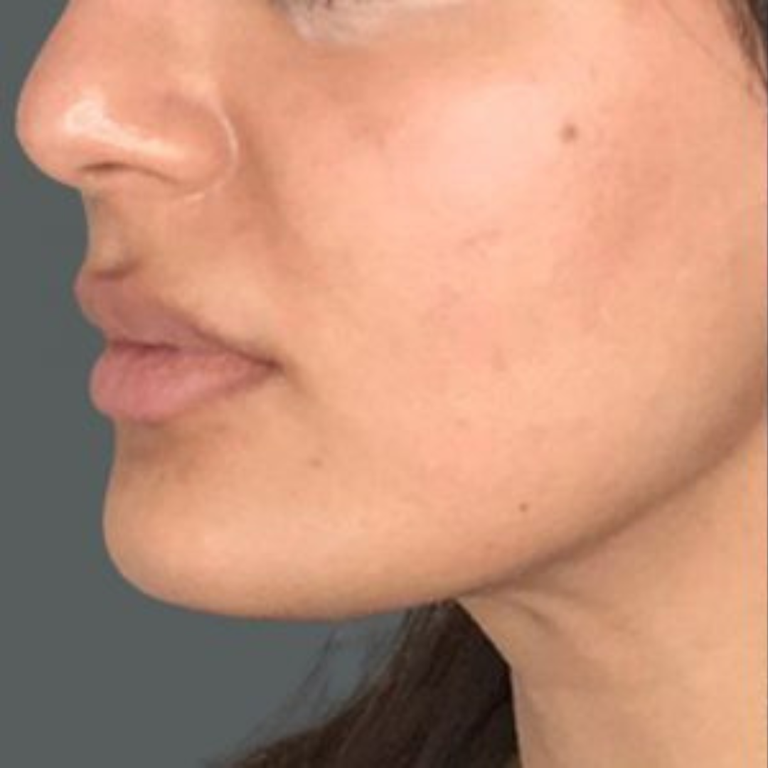 Close-up of a person's side profile showing nose, lips, and chin.