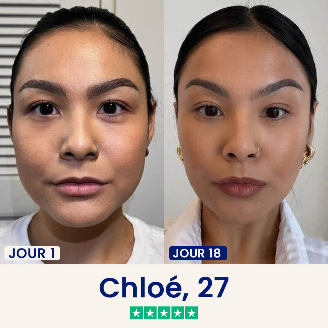 A side-by-side comparison of a woman's face, labeled 'Day 1' and 'Day 18', showing visible changes.