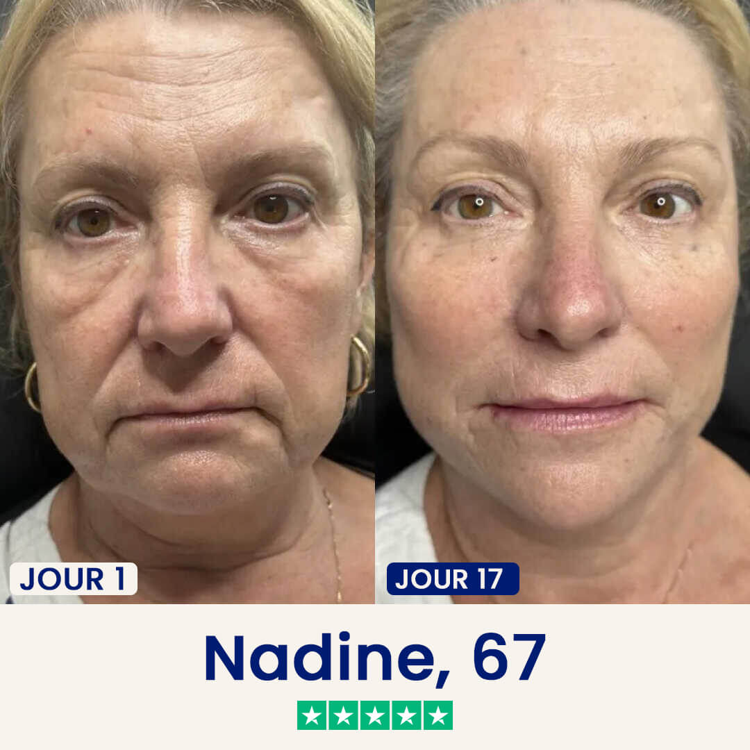 Before and after photos of a woman's face, showing a visible reduction in wrinkles from Day 1 to Day 17.