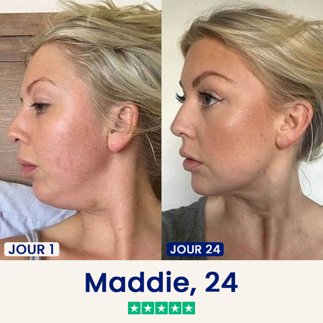 A before and after image showing a woman's facial profile, with improved jawline definition after 24 days.
