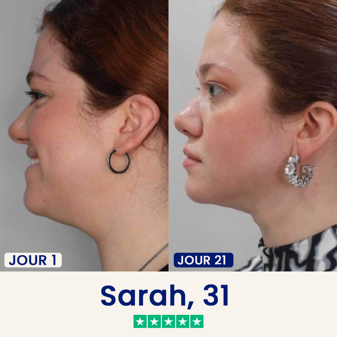 Before and after photos of a woman's side profile, labeled Day 1 and Day 21, showing jawline definition.