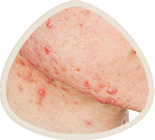 Close-up of skin with red acne or rash.