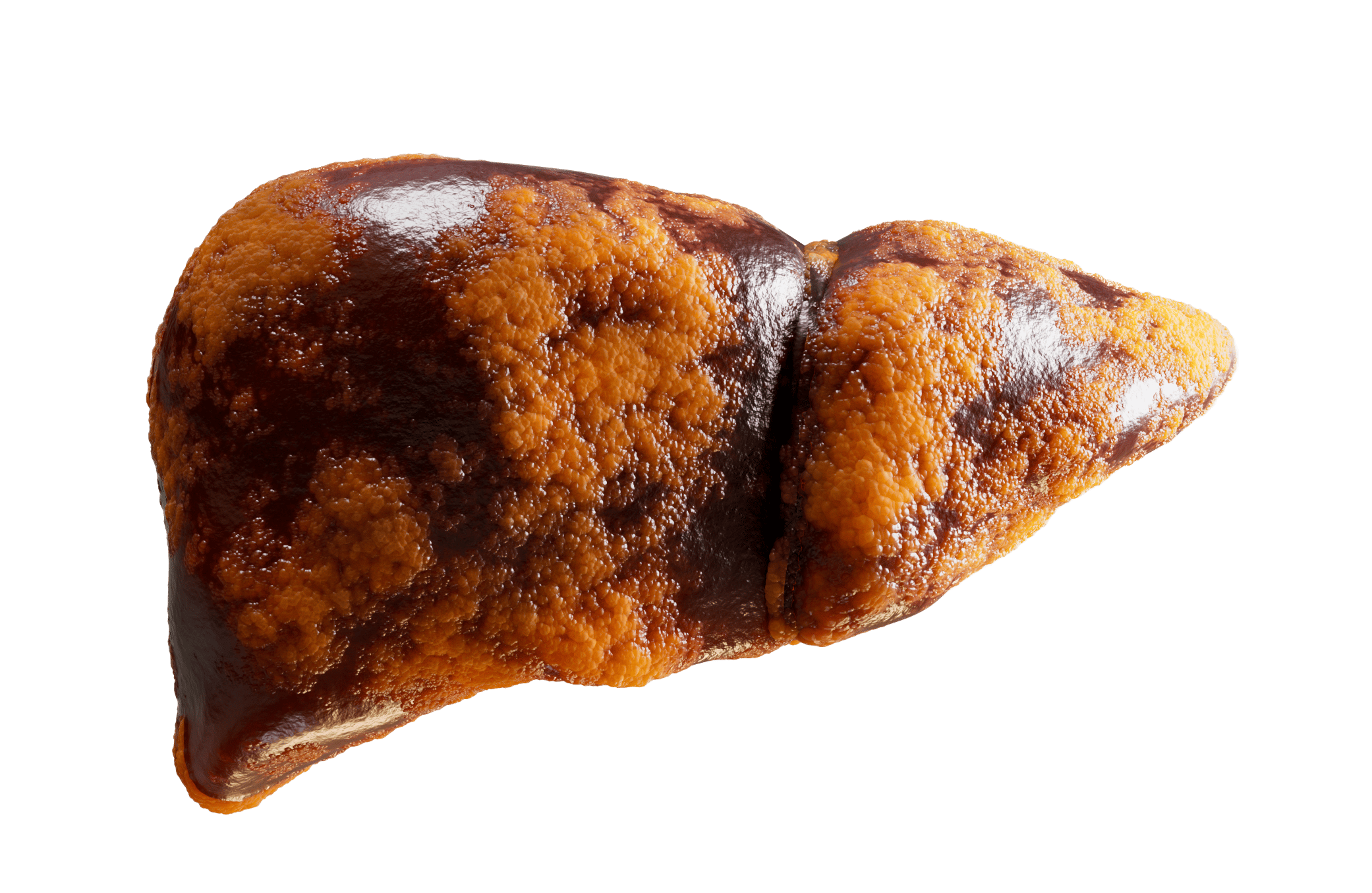 fatty_liver.png
