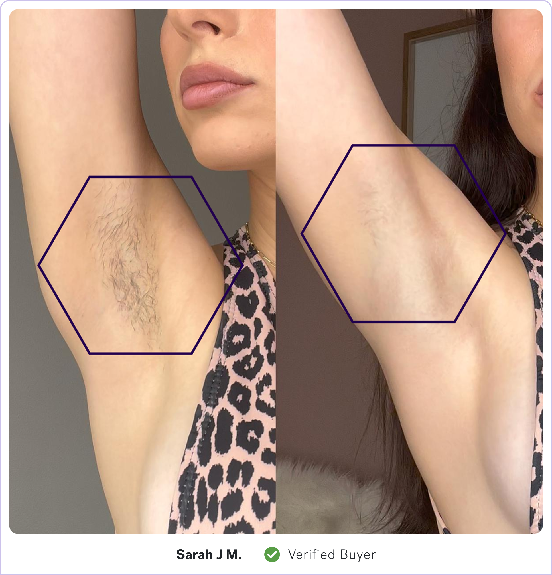 Before and after comparison of an armpit with and without hair.
