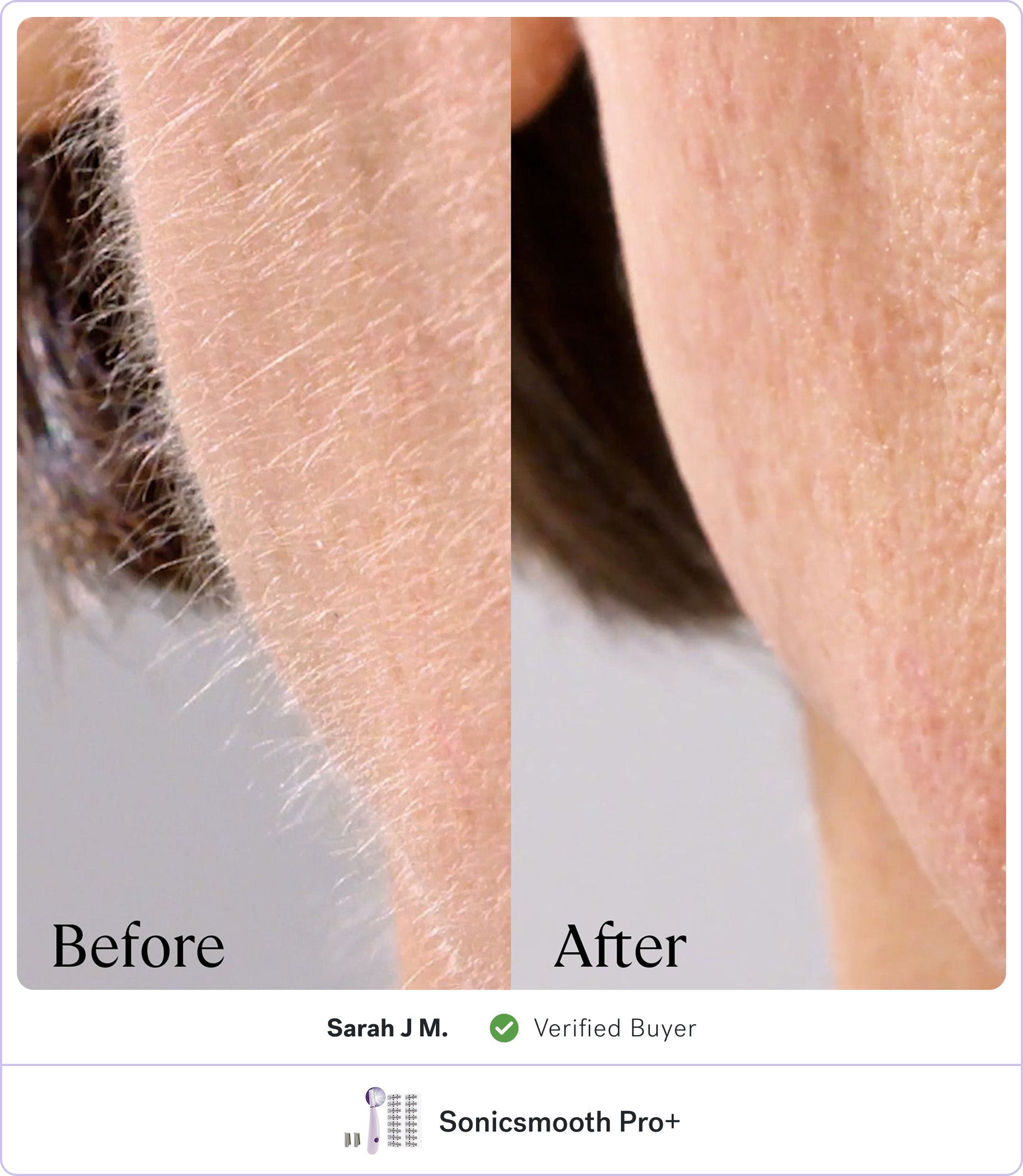 Side-by-side comparison of skin before and after hair removal.