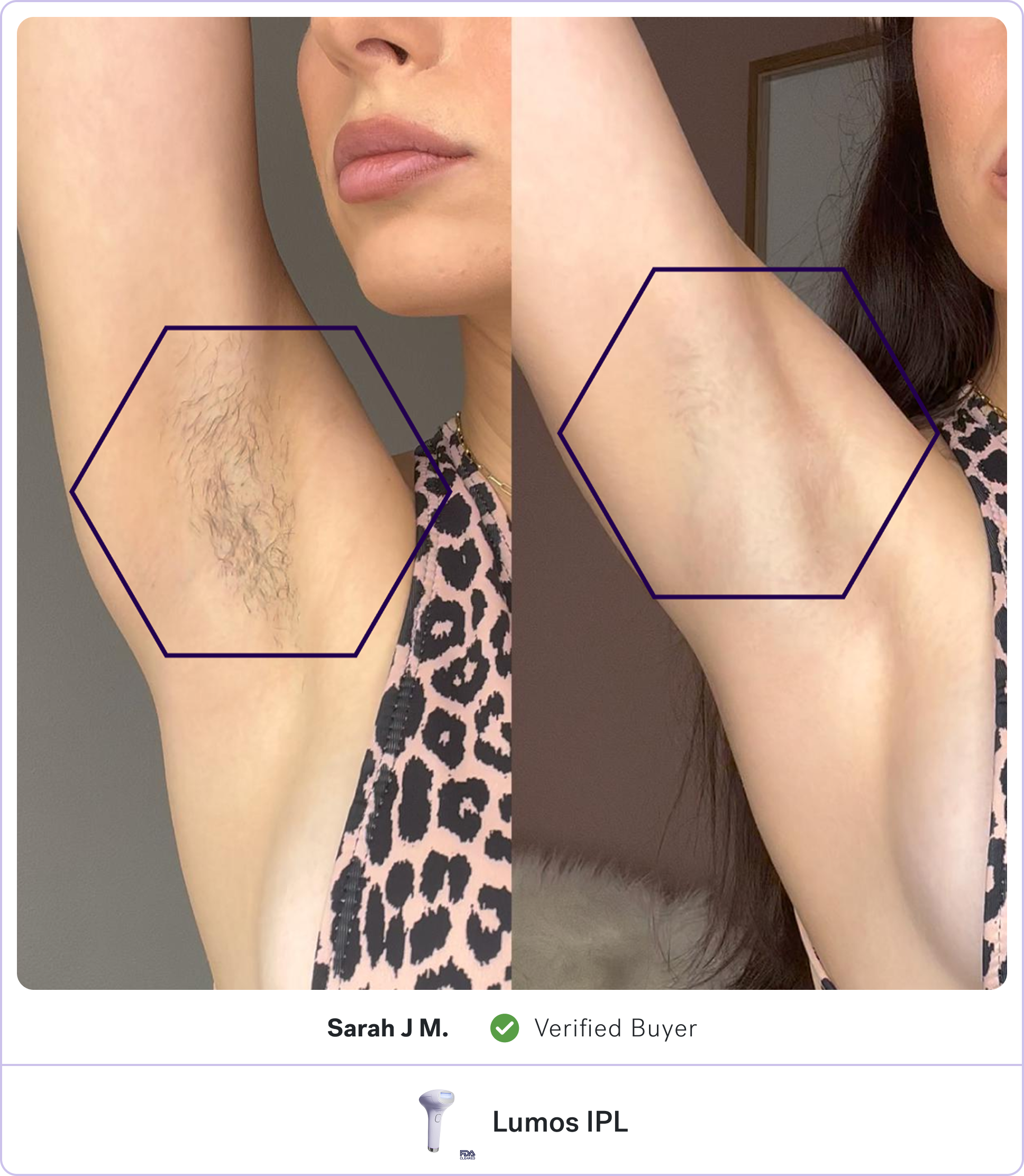 Comparison of underarm with and without hair.