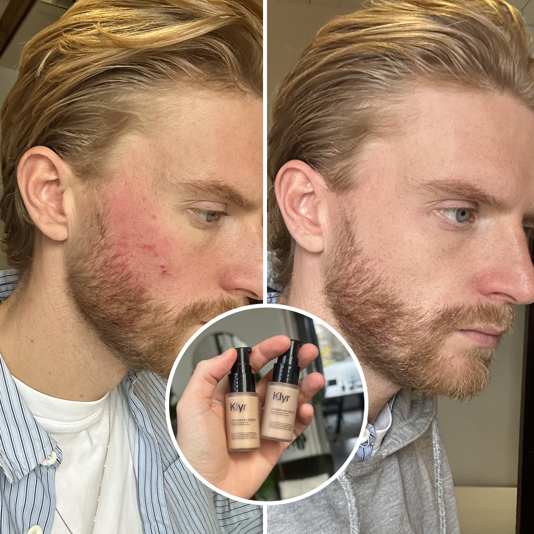 A before and after image showing a man's facial redness and blemishes reduced after using a product.