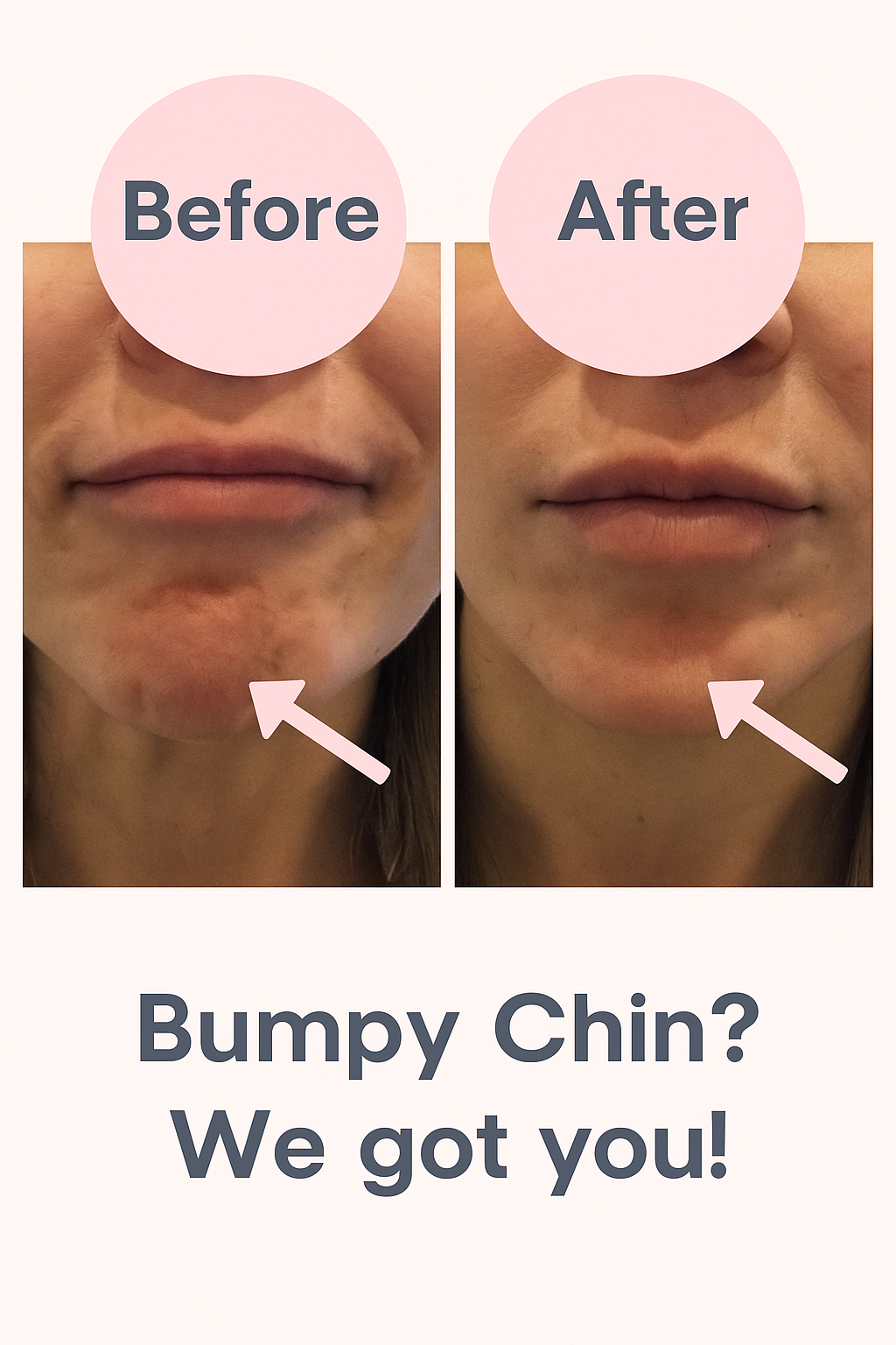 Before and after images of a chin with text 'Bumpy Chin? We got you!'.