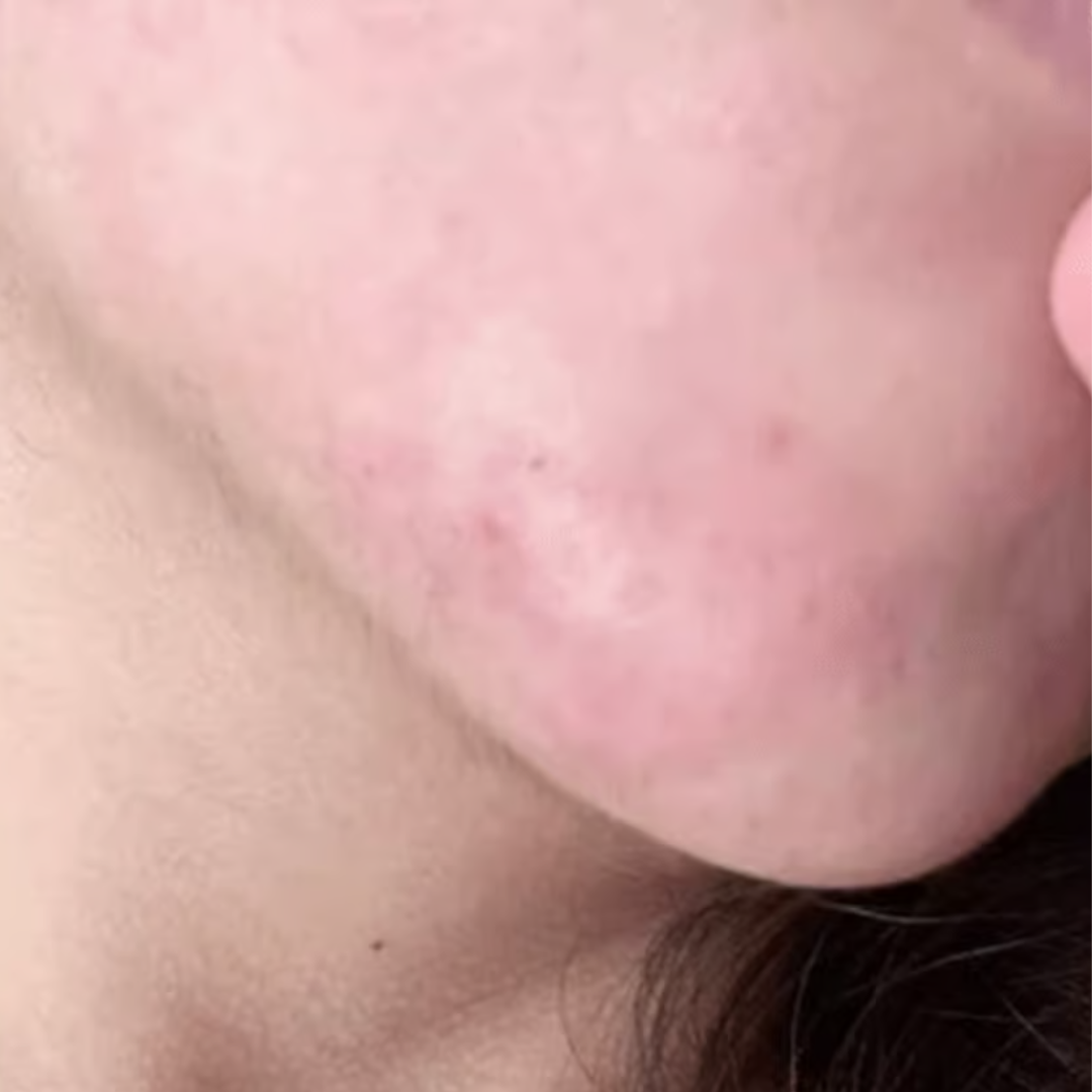 Close-up of a person's cheek with visible skin texture.