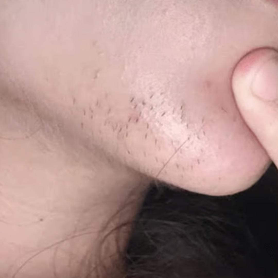 Close-up of a person's chin with stubble and a finger touching it.