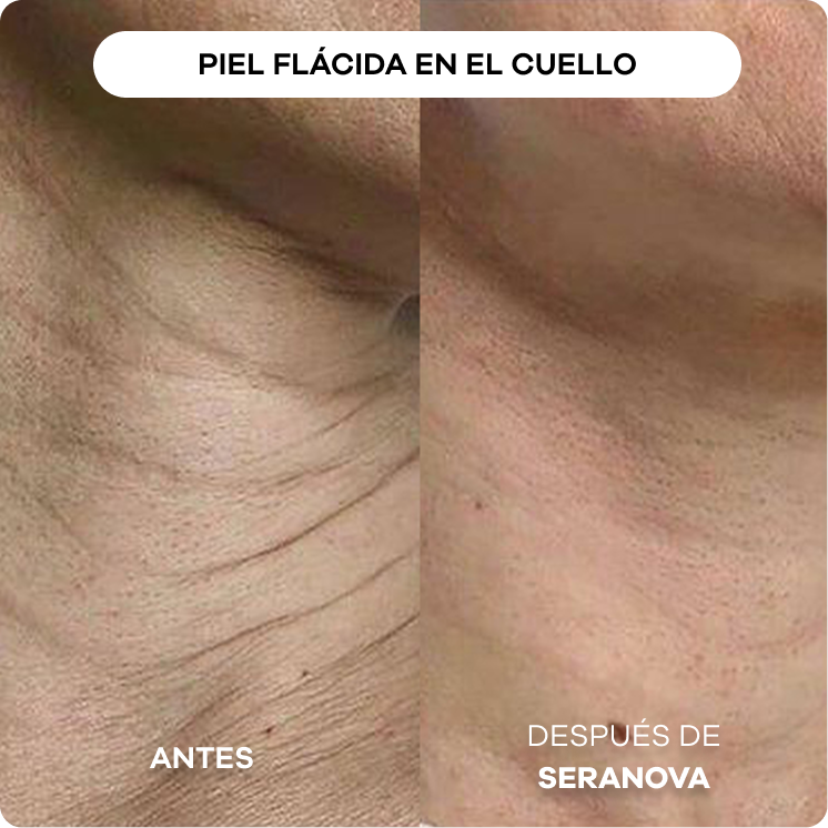 Comparison of neck skin before and after treatment.
