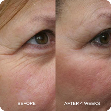 Close-up of an eye showing skin before and after four weeks of treatment.