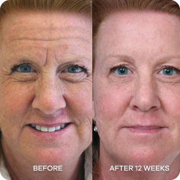 Side-by-side comparison of a woman's face before and after 12 weeks.