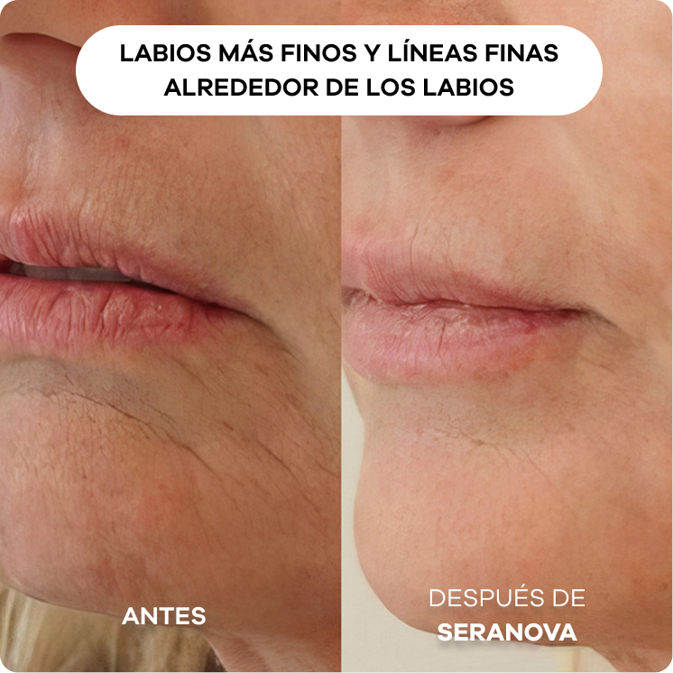 Before and after comparison of lips and surrounding skin.