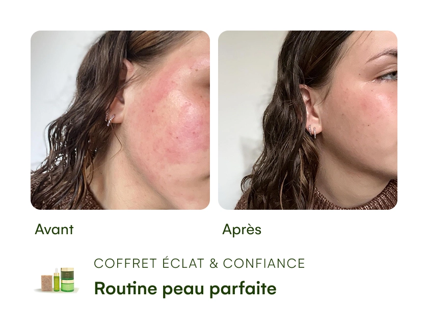 Before and after skincare comparison of a woman's cheek.