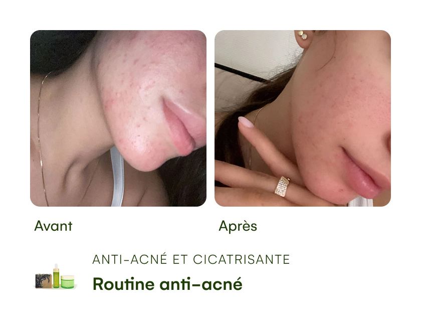 Before and after images of acne treatment on a woman's face.