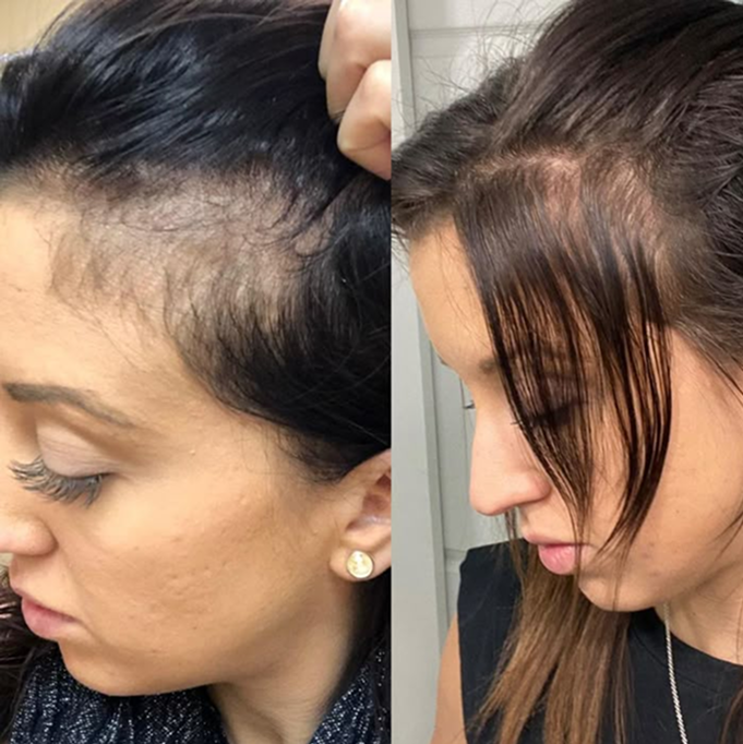 Two women showing hair thinning on the sides of their heads.