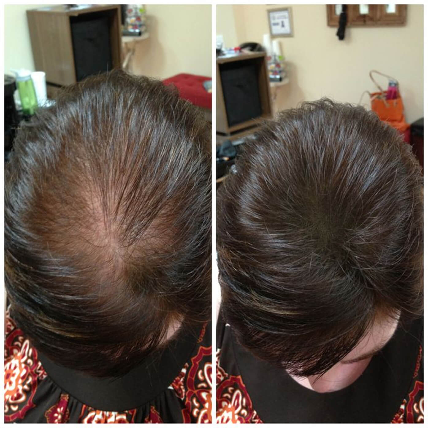 Before and after images showing hair thinning and fuller hair.