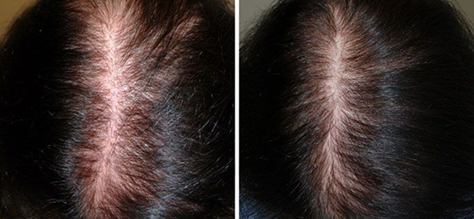 Comparison of hair density on a scalp, before and after treatment.