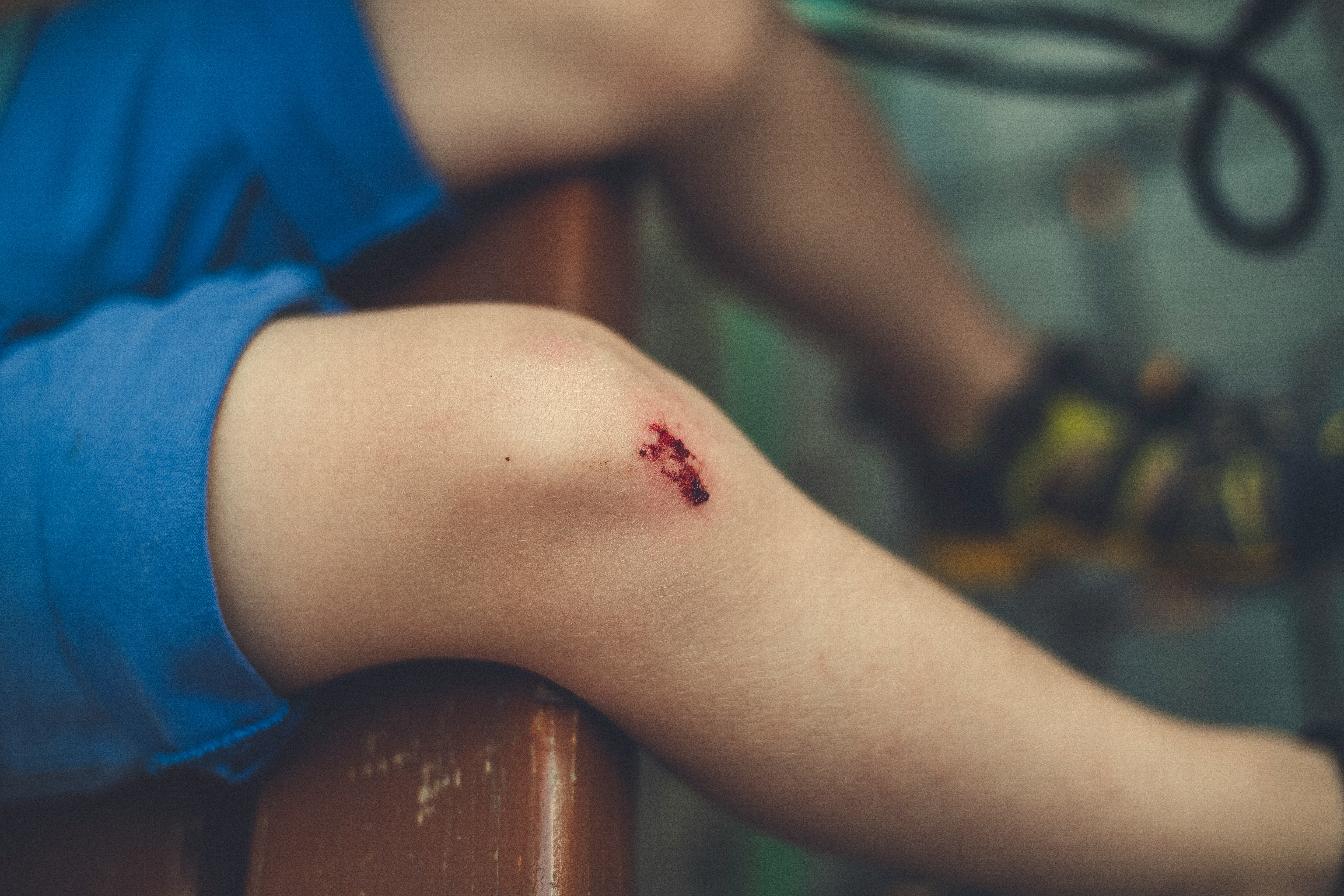 Child's knee with a small scrape and bruise.