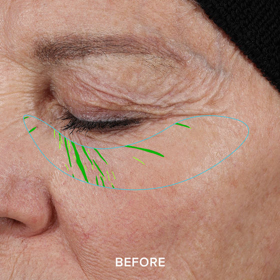 Close-up of a closed eye with a graphic overlay, labeled 'Before.'