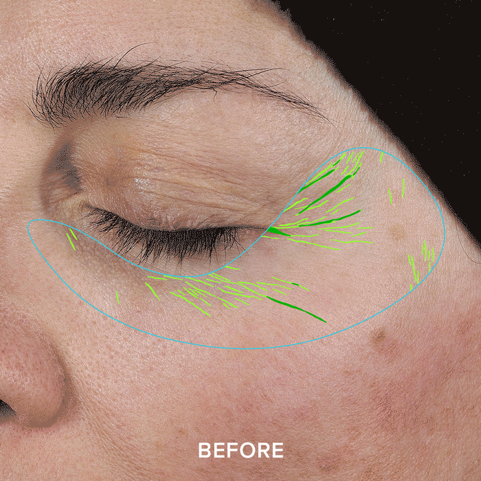 Close-up of a closed eye with green lines and 'BEFORE' text.