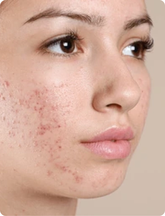 Close-up of a person's face with acne on the cheek.