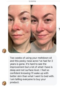 Clear Skin Kit: Acne Essentials