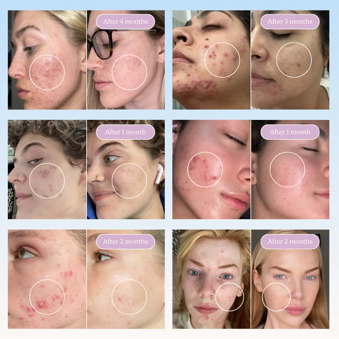 A collage of faces with acne and labels indicating time progress in months.