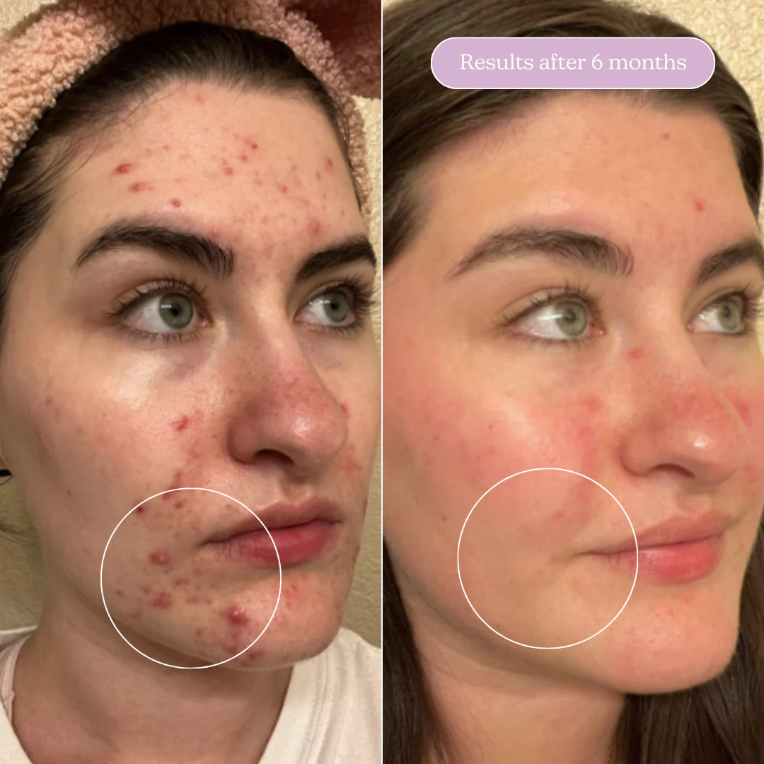 Side-by-side facial skin improvement over six months, showing reduced acne.