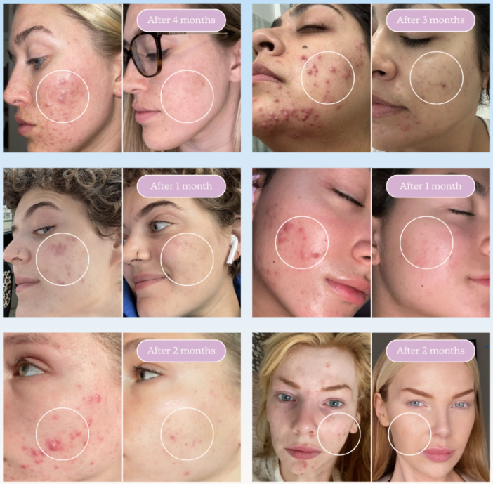 Collage of facial skin progress over time with acne improvement.