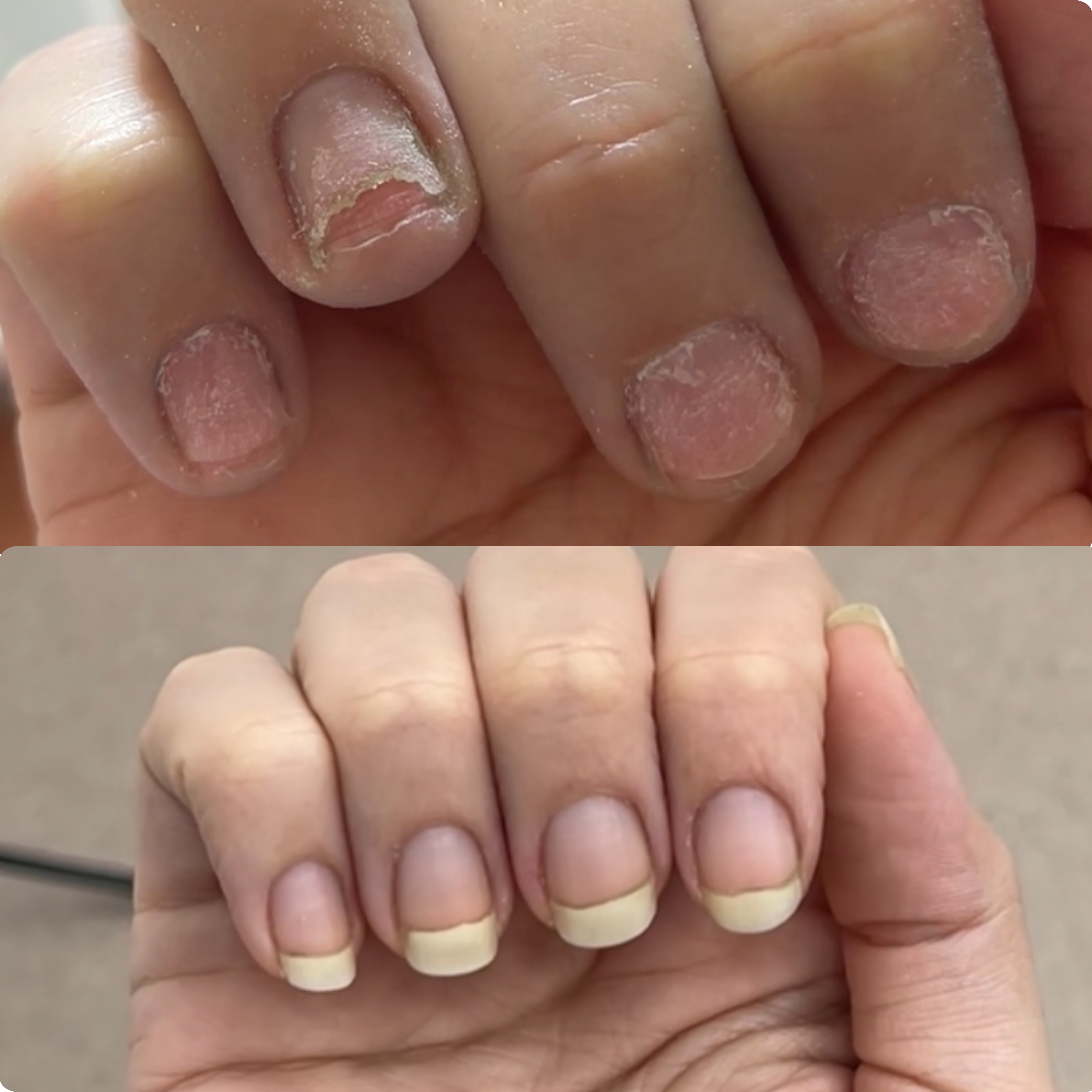 A before-and-after image showing a hand with damaged, peeling nails transforming into healthy, grown-out nails.