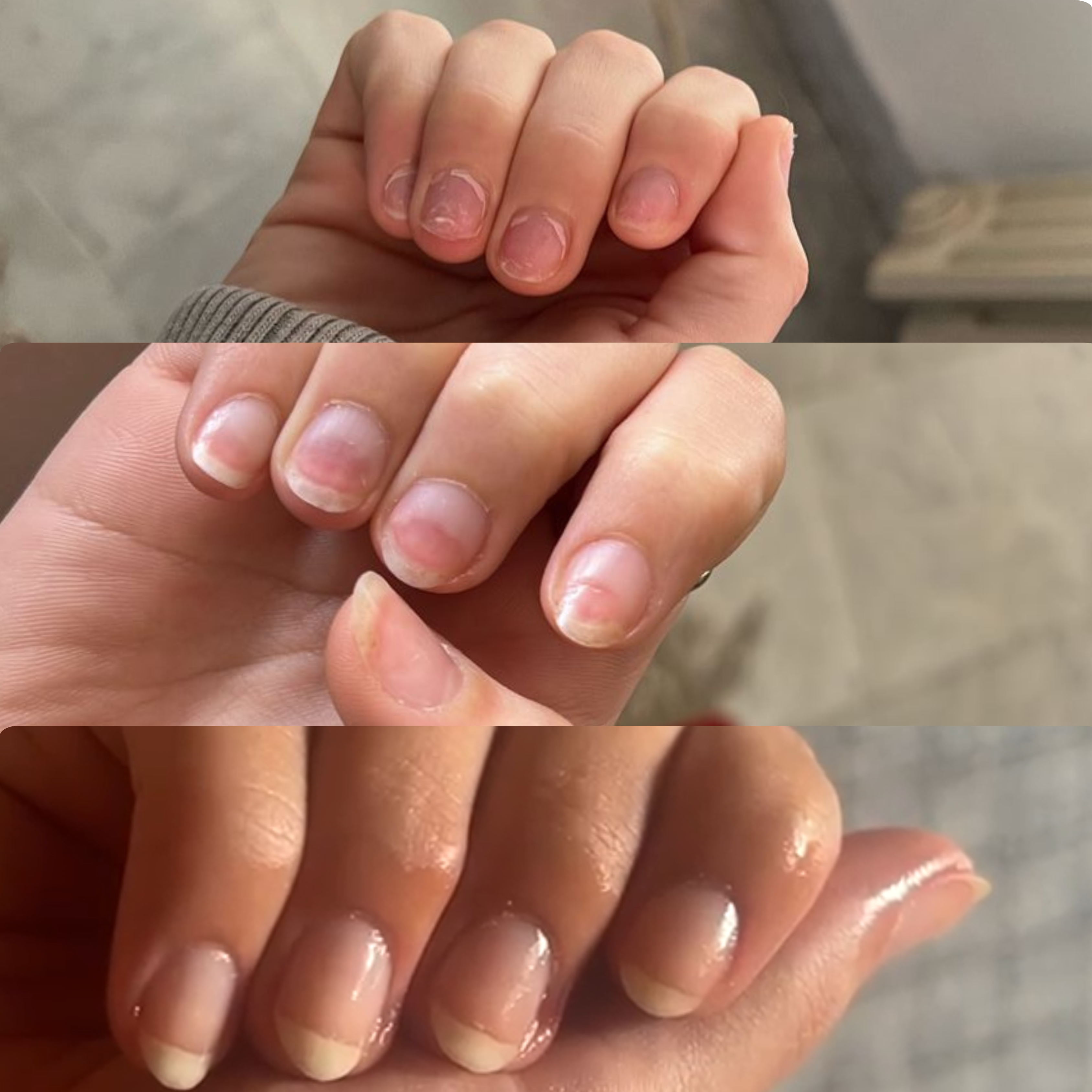 A collage of three images showing the progression of fingernails from short and damaged to long and healthy.