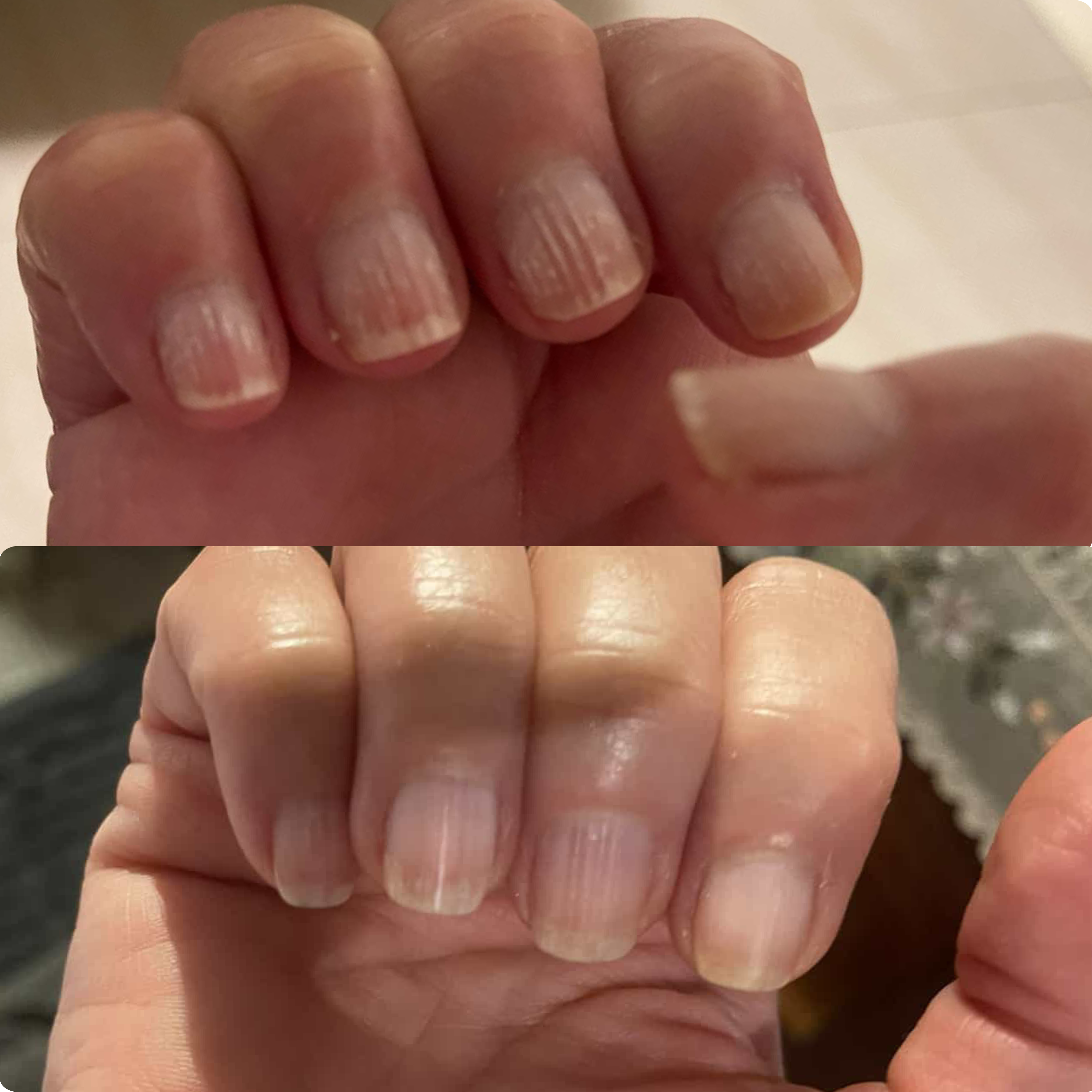 A before-and-after comparison of a hand's fingernails, showing them change from ridged to smoother and healthier-looking.