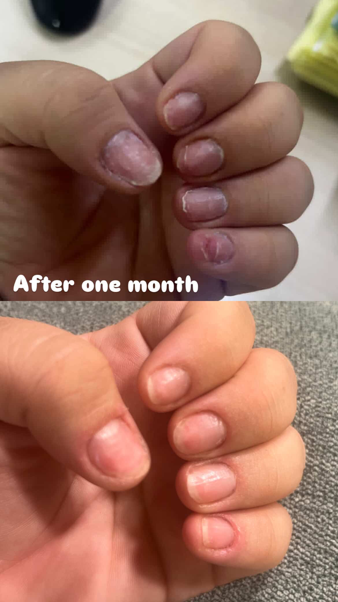 Two close-up images of fingernails, showing condition before and after one month.
