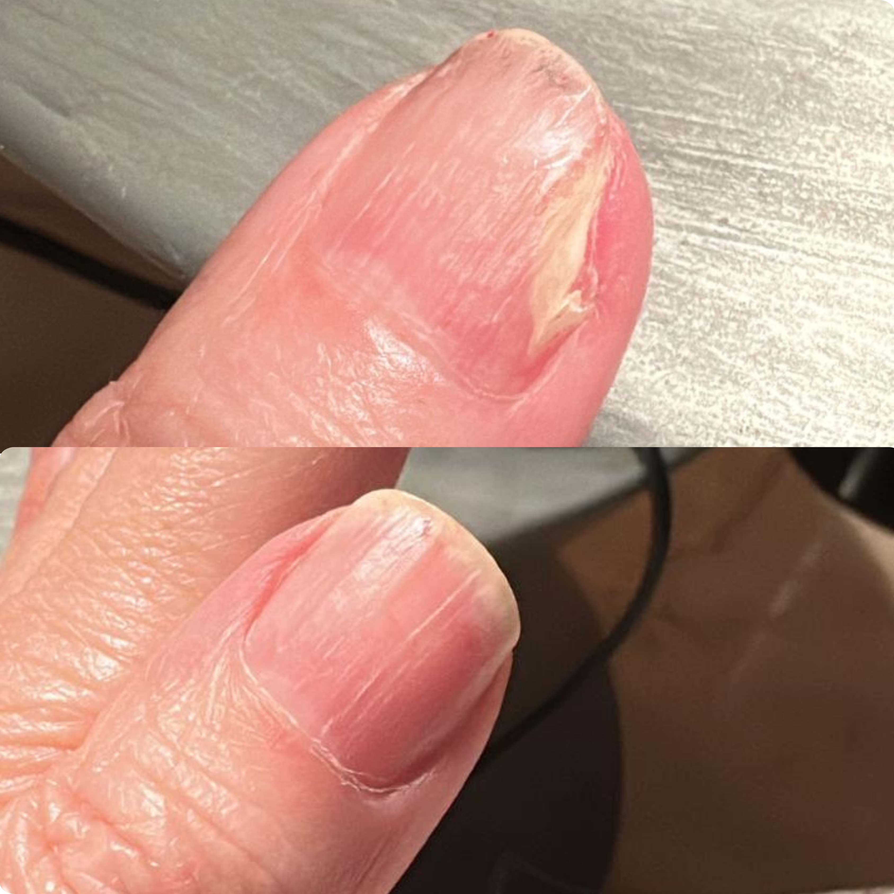 A before-and-after comparison of a damaged fingernail that has been repaired and is now healthy.