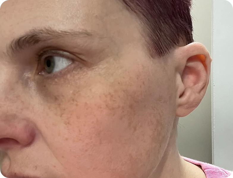 A close-up of the side of a person's face, showing dark spots and hyperpigmentation on the cheek.