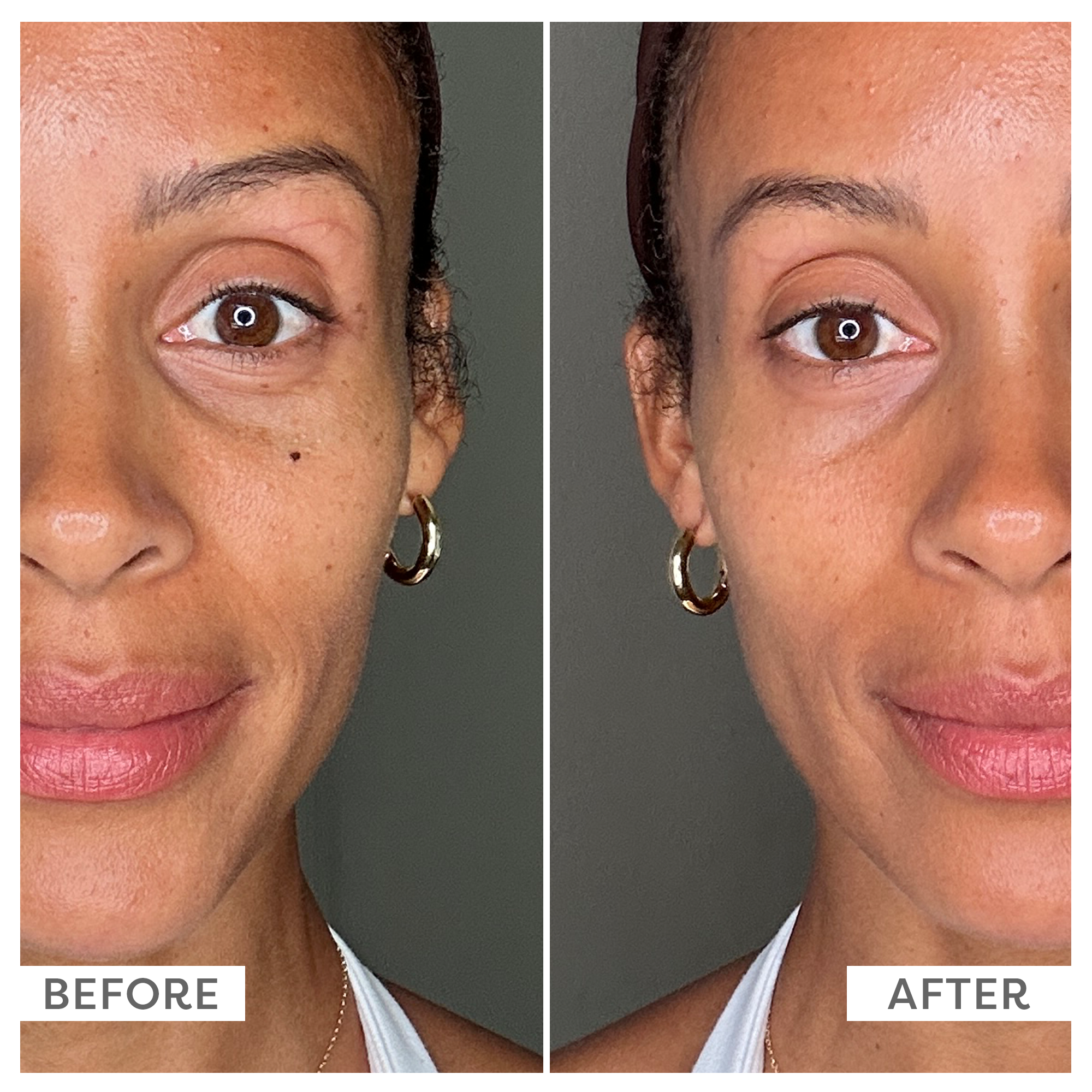 A before-and-after comparison of a woman's face, showing a reduction in under-eye darkness and fine lines.