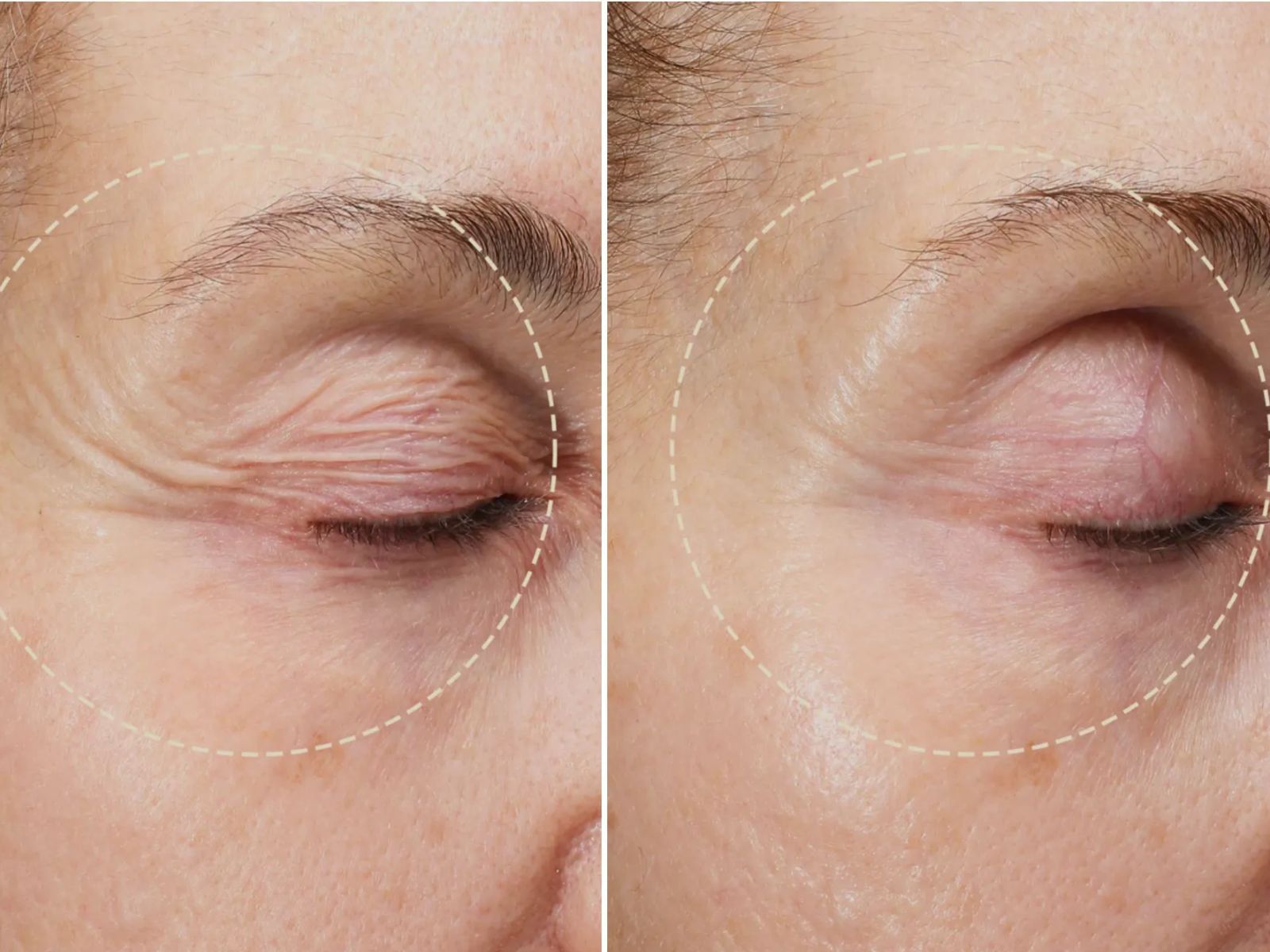 Close-up of an eye before and after treatment, showing reduced wrinkles.