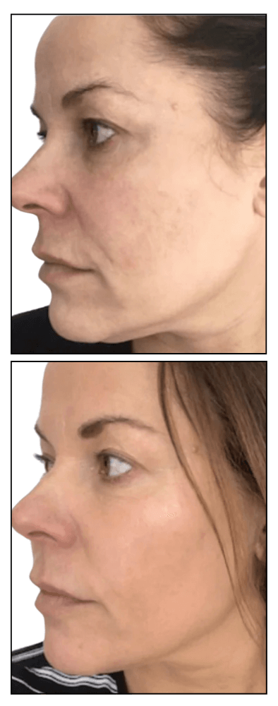 Side-by-side comparison of a woman's face before and after treatment.