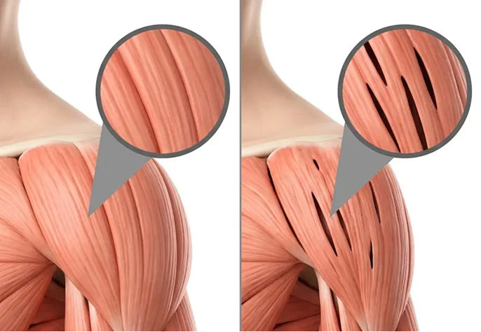 Anatomical illustration comparing healthy, intact shoulder muscle fibers to torn muscle fibers.