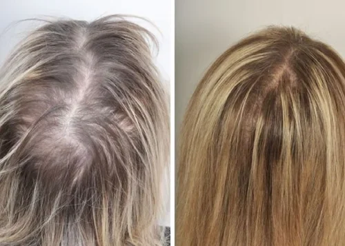 Comparison of hair before and after treatment, showing thicker hair on the right.