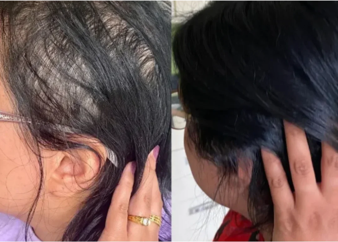 Two images showing hair growth on a person's scalp.