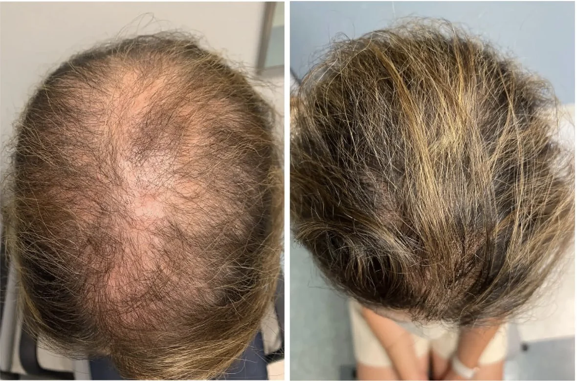 Two side-by-side images showing hair thinning and regrowth on the top of a person's head.