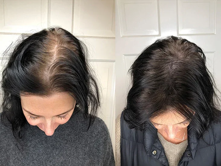 Two side-by-side images showing hair before and after treatment.