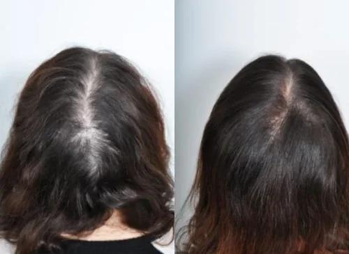 Comparison of hair from the back, showing before and after treatment.